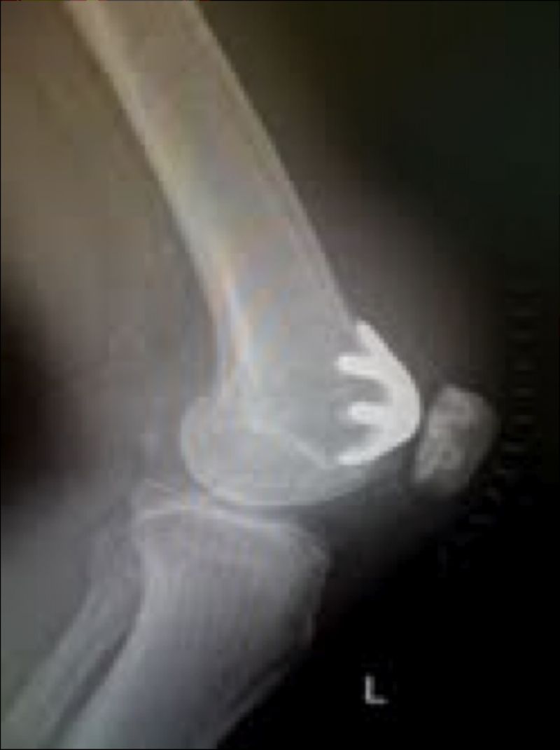 Knee Prostheses:  Patellofemoral:  MAKO (Implant 4236)
